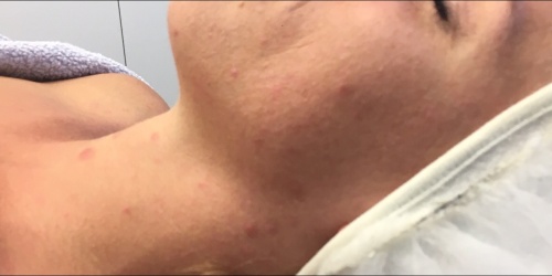 acne behandeling Aqua Dôme Maarkedal