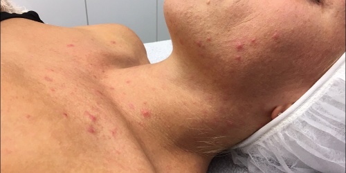 acne behandeling Aqua Dôme Maarkedal