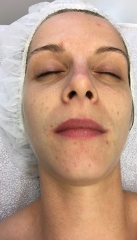 acne behandeling aqua dome maarkedal oudenaarde
