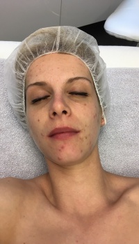 acne behandeling maarkedal oudenaarde ronse